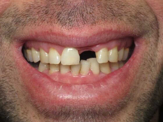 Individual Implants Front Dental Implants for Two Missing Front Teeth - Before