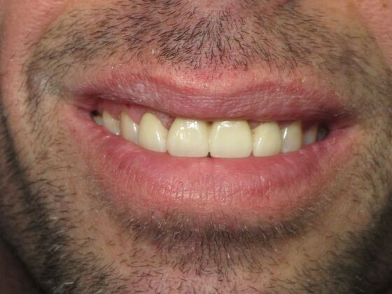 Individual Implants Front Dental Implants for Two Missing Front Teeth - After