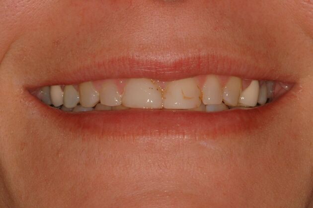 Porcelain Veneers Case 10- Ridgewood, NJ - Before
