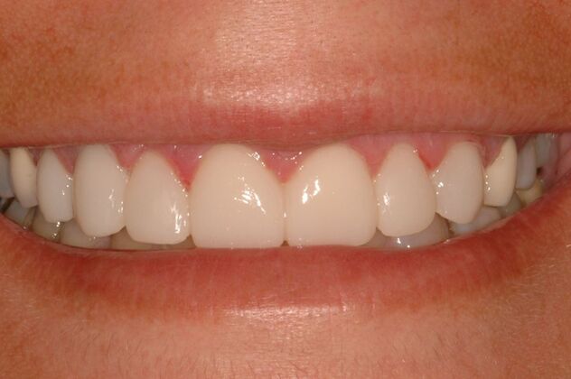 Porcelain Veneers Case 10- Ridgewood, NJ - After