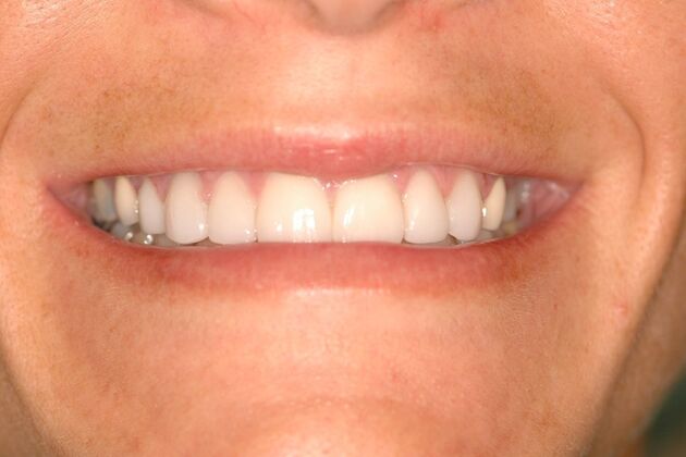 Porcelain Veneers: Case 10- Ridgewood, NJ - After