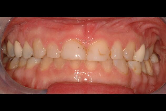 Porcelain Veneers: Case 10- Ridgewood, NJ - Before - Retracted