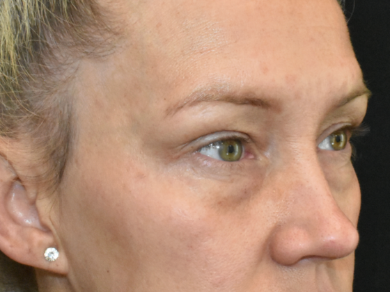 Eye Lift (Blepharoplasty): Case 4 - Before