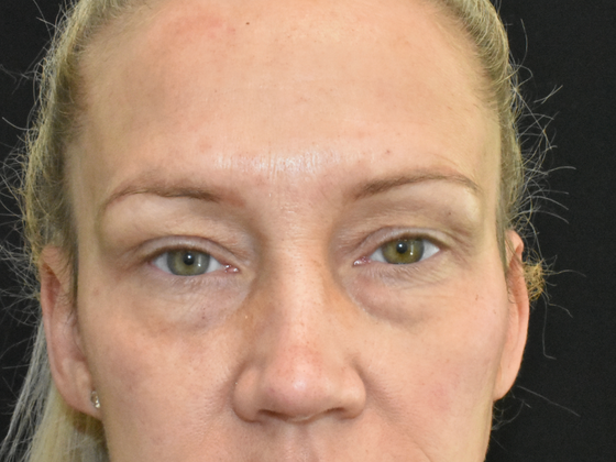 Eye Lift (Blepharoplasty) Case 4 - Before