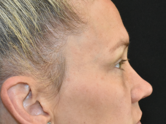 Eye Lift (Blepharoplasty): Case 4 - Before