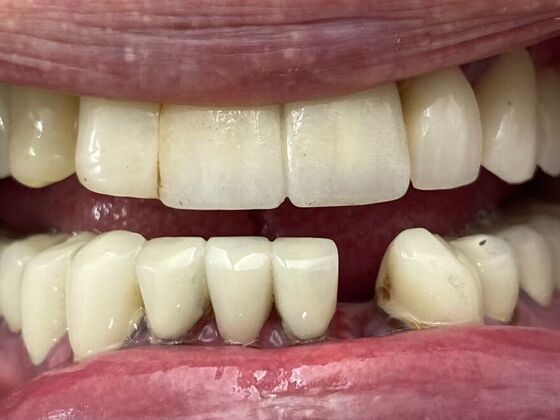 Dr. Andrews Work  Louie Hollis  - Before