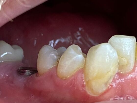 Dr. Andrews Work : Todd Devasure - Before