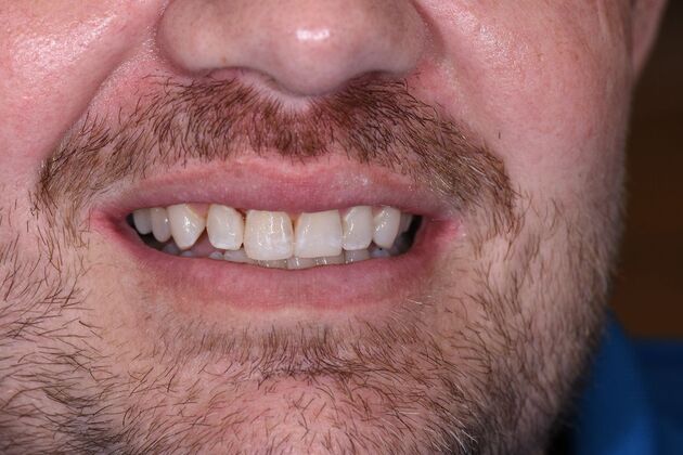 Dr. Bates Work : Brett Edwards - After