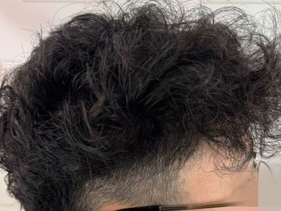 FUE Hair Restoration: Case 50 - After