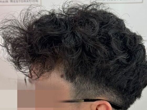FUE Hair Restoration Case 50 - After