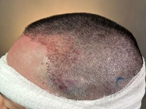 FUE Hair Restoration: Case 50 - After