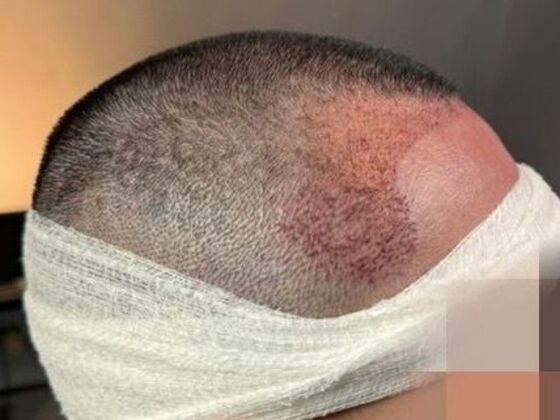 FUE Hair Restoration: Case 50 - After