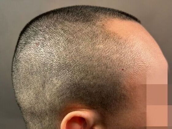 FUE Hair Restoration: Case 50 - Before