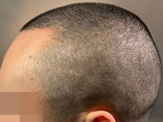 FUE Hair Restoration: Case 50 - Before