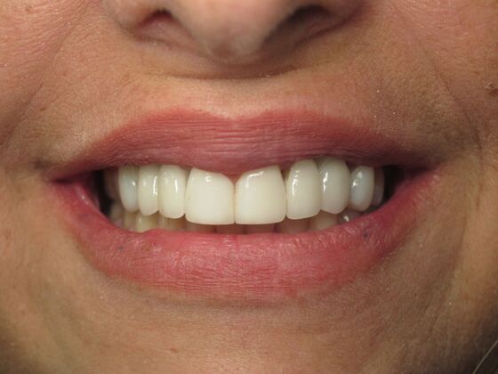 Cosmetic Crowns: Cosmetic Crowns and Implants for Missing Front Teeth - After