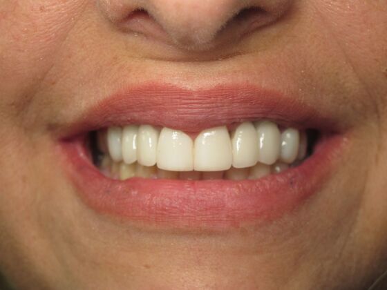 Cosmetic Crowns: Cosmetic Crowns and Implants for Missing Front Teeth - After