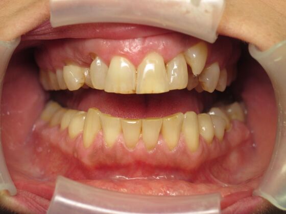 Cosmetic Crowns: Cosmetic Crowns and Implants for Missing Front Teeth - Before