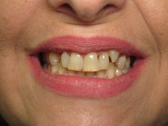 Cosmetic Crowns: Cosmetic Crowns and Implants for Missing Front Teeth - Before