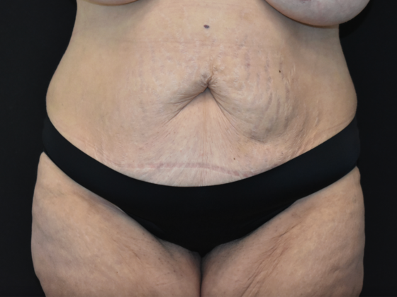 Abdominoplasty Case 40 - Before