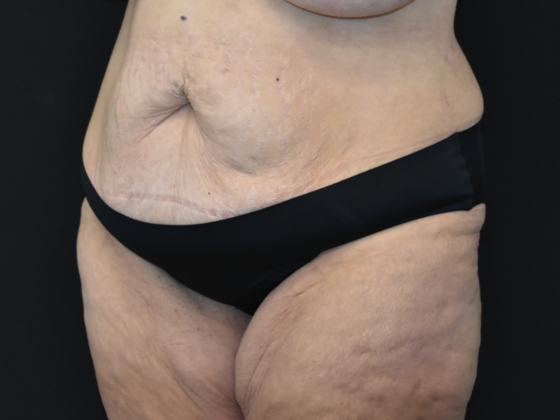 Abdominoplasty: Case 40 - Before