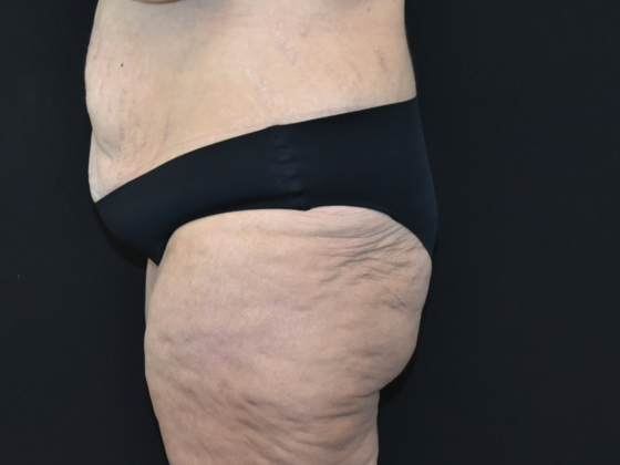 Abdominoplasty: Case 40 - Before