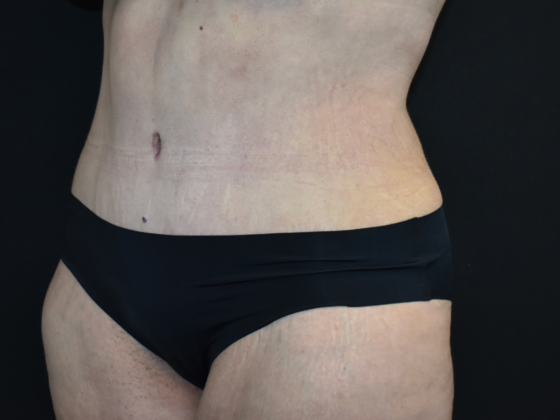 Abdominoplasty: Case 40 - After