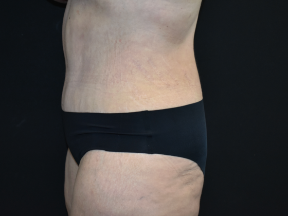 Abdominoplasty: Case 40 - After