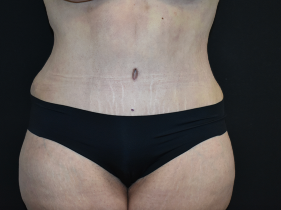 Abdominoplasty Case 40 - After