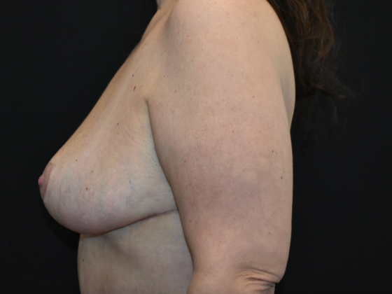 Breast Reduction: Case 14 - After