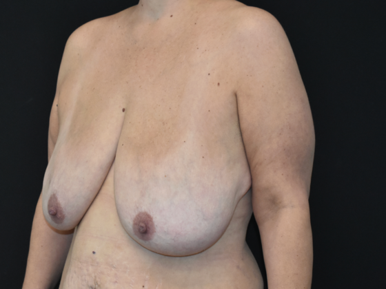 Breast Reduction: Case 14 - Before