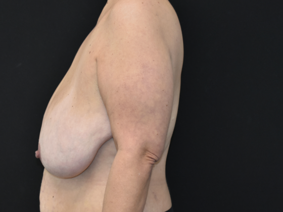Breast Reduction: Case 14 - Before