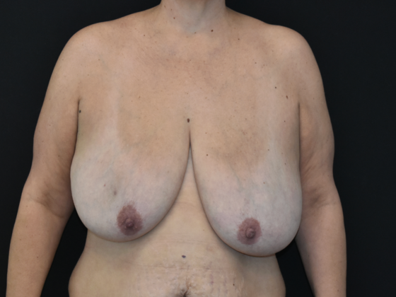 Breast Reduction Case 14 - Before