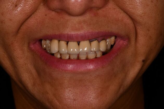 Cosmetic Crowns: Cosmetic Crowns and Individual Implants for a Brighter, Complete Smile - Before