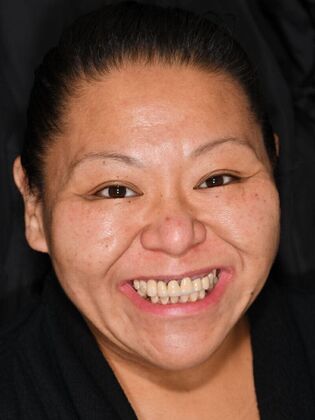 Cosmetic Crowns Cosmetic Crowns and Individual Implants for a Brighter, Complete Smile - Before
