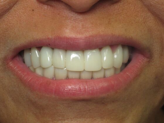 Cosmetic Crowns: Cosmetic Crowns and Individual Implants for a Brighter, Complete Smile - After