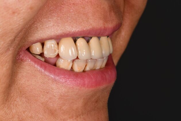 Cosmetic Crowns: Cosmetic Crowns and Individual Implants for a Brighter, Complete Smile - Before