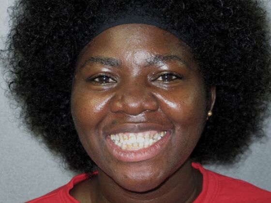 Cosmetic Crowns Cosmetic Crowns for Childhood Discoloration and a Confident Smile - Before