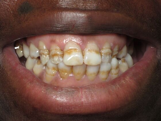 Cosmetic Crowns: Cosmetic Crowns for Childhood Discoloration and a Confident Smile - Before