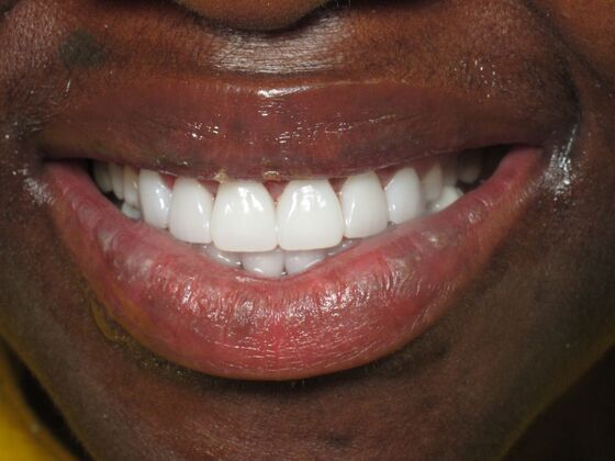 Cosmetic Crowns: Cosmetic Crowns for Childhood Discoloration and a Confident Smile - After