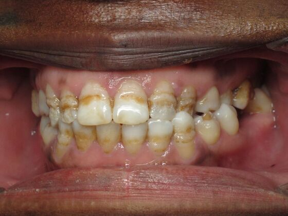 Cosmetic Crowns: Cosmetic Crowns for Childhood Discoloration and a Confident Smile - Before