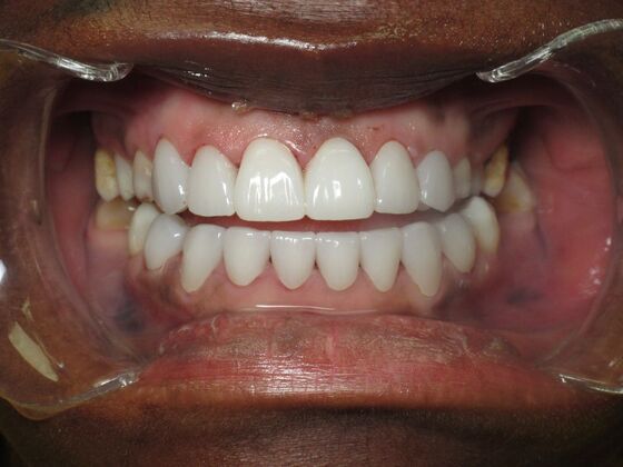 Cosmetic Crowns: Cosmetic Crowns for Childhood Discoloration and a Confident Smile - After