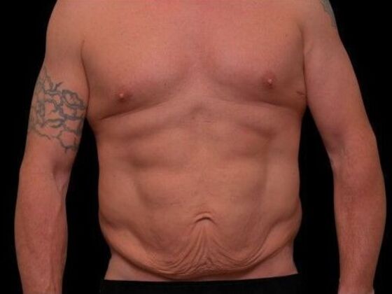 Male Procedures Case 1 - Before