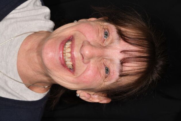 Cosmetic Crowns Four Upper Front Crowns for a Brighter, More Even Smile - Before