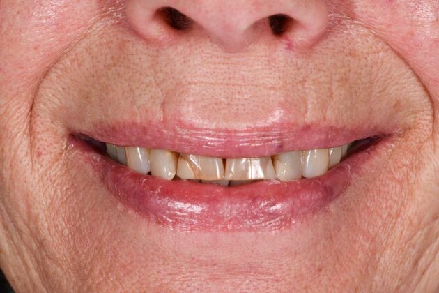 Cosmetic Crowns: Four Upper Front Crowns for a Brighter, More Even Smile - Before