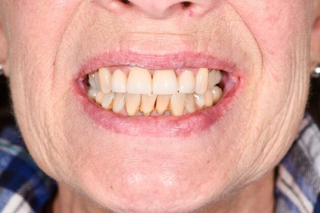 Cosmetic Crowns: Four Upper Front Crowns for a Brighter, More Even Smile - After