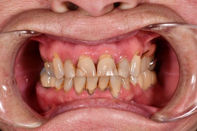 Cosmetic Crowns: Four Upper Front Crowns for a Brighter, More Even Smile - Before