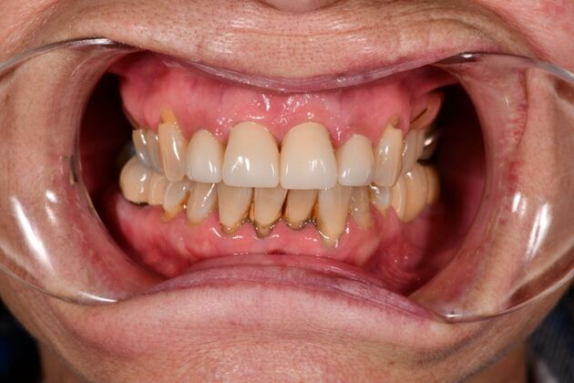 Cosmetic Crowns: Four Upper Front Crowns for a Brighter, More Even Smile - After