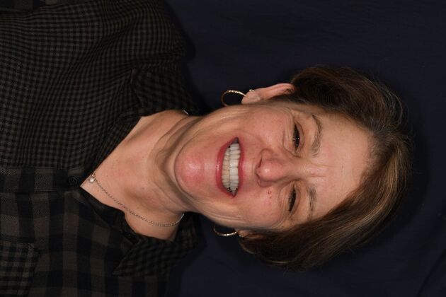 Cosmetic Crowns Ten Upper Cosmetic Crowns for a Fuller, Brighter Smile - After