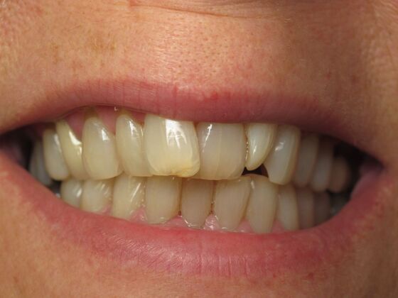 Cosmetic Crowns: Ten Upper Cosmetic Crowns for a Fuller, Brighter Smile - Before