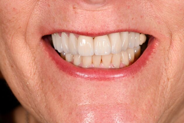 Cosmetic Crowns: Ten Upper Cosmetic Crowns for a Fuller, Brighter Smile - After